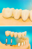 Festsitzender Zahnersatz durch Implantate oder Brücken, Zahnmedizin in Mannheim